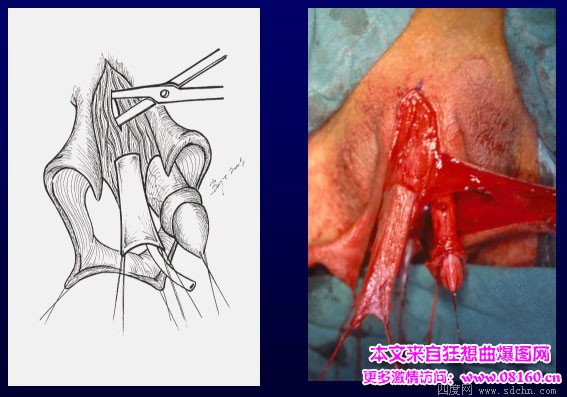 泰国男变性女手术视频，女人变性手术过程照片
