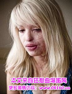 被泼硫酸女生照片图，女生被泼硫酸的案例