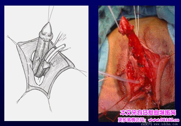 泰国男变性女手术视频，女人变性手术过程照片